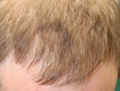Hair Restoration with Exosomes Before & After Gallery - Patient 49275868 - Image 4