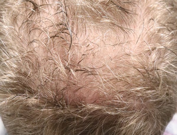 Hair Restoration with Exosomes Gallery - Patient 49275868 - Image 7