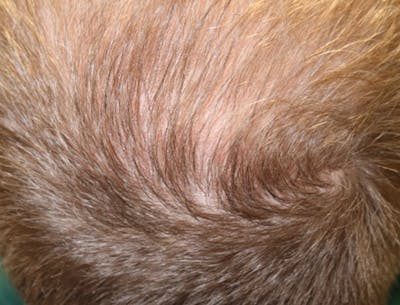 Hair Restoration with Exosomes Before & After Gallery - Patient 49275868 - Image 8