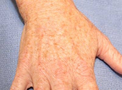 Microneedling Before & After Gallery - Patient 77040322 - Image 4