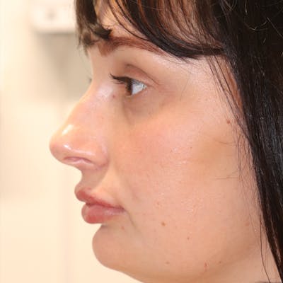 Lip Lift Before & After Gallery - Patient 77036732 - Image 6