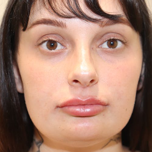 Patient Before and After a Lip Lift in Austin with Dr. Givens