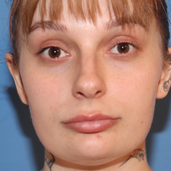 Lip Lift Before & After Gallery - Patient 77036732 - Image 1