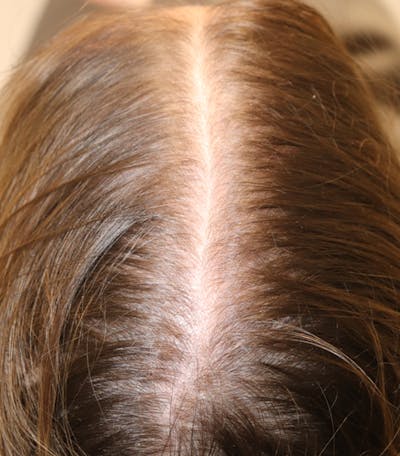 Hair Restoration with Exosomes Gallery - Patient 77037162 - Image 2