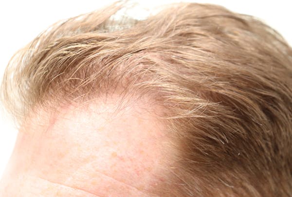 Hair Restoration PRP Before & After Gallery - Patient 77037308 - Image 3