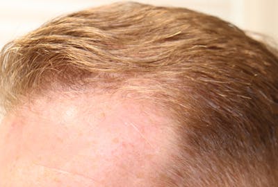 Hair Restoration PRP Before & After Gallery - Patient 77037308 - Image 4