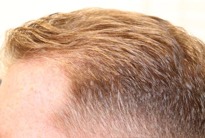 Hair Restoration PRP Before & After Gallery - Patient 77037308 - Image 6