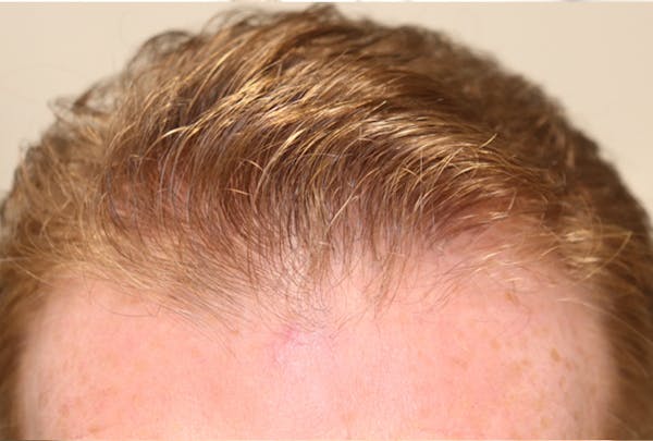 Hair Restoration PRP Before & After Gallery - Patient 77037308 - Image 2