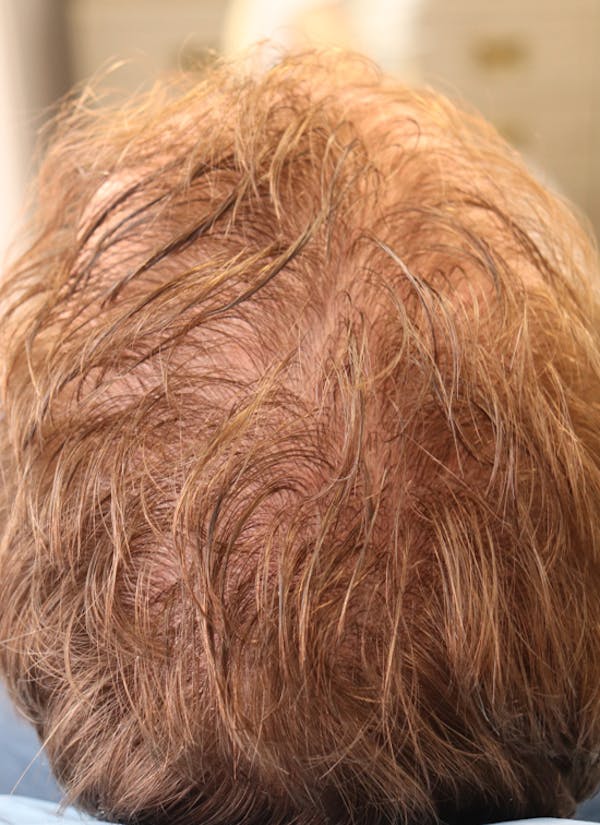 Hair Restoration PRP Before & After Gallery - Patient 77037308 - Image 7