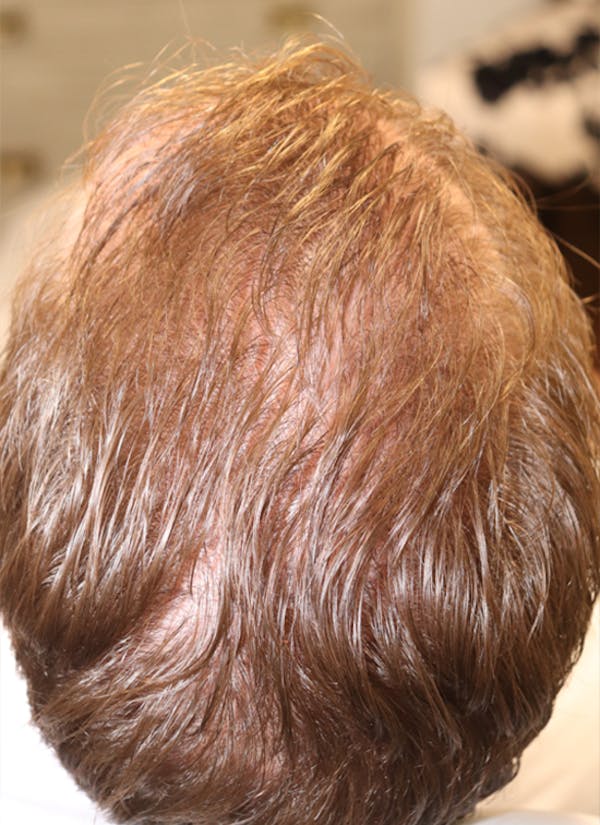 Hair Restoration PRP Before & After Gallery - Patient 77037308 - Image 8