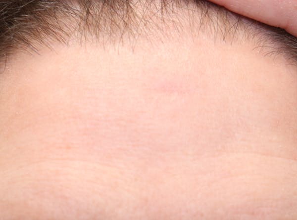Microneedling Before & After Gallery - Patient 77040367 - Image 2