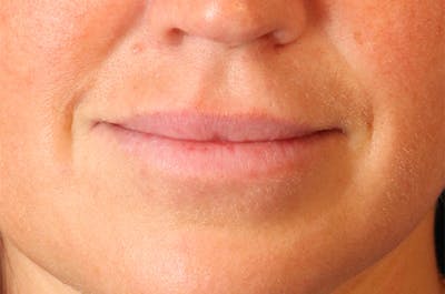 Filler Refinement Before & After Gallery - Patient 77038538 - Image 1