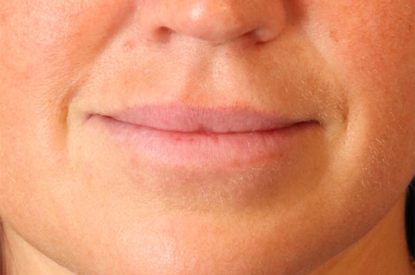 Lip Filler Before & After Gallery - Patient 144976901 - Image 1