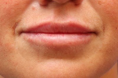 Lip Filler Before & After Gallery - Patient 144976901 - Image 2