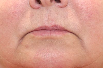 Filler Refinement Before & After Gallery - Patient 77038859 - Image 1
