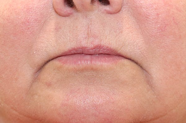 Lip Filler Before & After Gallery - Patient 144976905 - Image 1