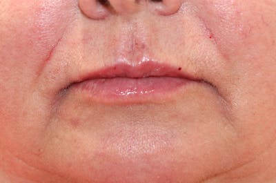 Lip Filler Before & After Gallery - Patient 144976905 - Image 2