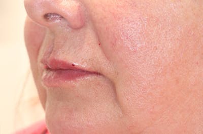 Lip Filler Before & After Gallery - Patient 144976905 - Image 4
