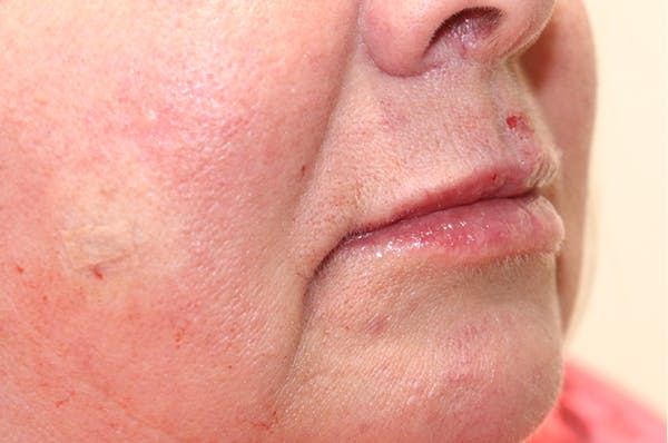 Lip Filler Before & After Gallery - Patient 144976905 - Image 6