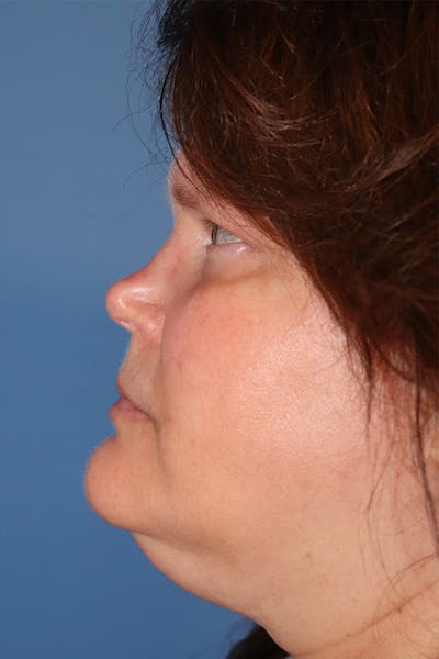 Rhinoplasty Before & After Gallery - Patient 77036996 - Image 1