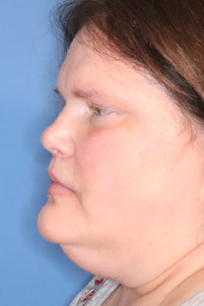 Rhinoplasty Before & After Gallery - Patient 77036996 - Image 2