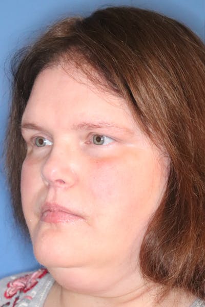 Rhinoplasty Before & After Gallery - Patient 77036996 - Image 4