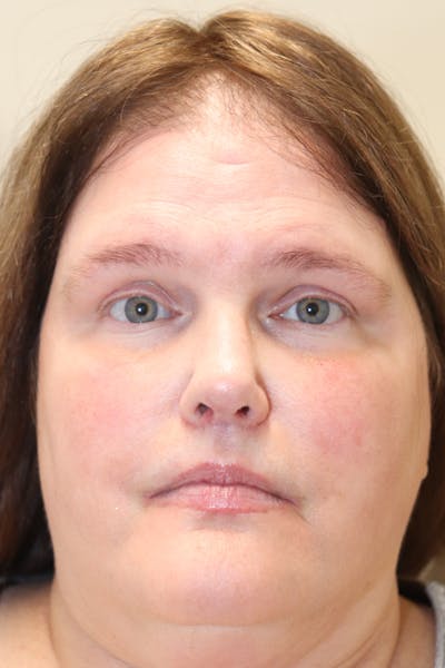 Rhinoplasty Before & After Gallery - Patient 77036996 - Image 6