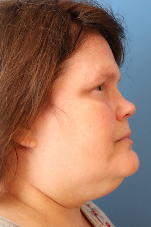 Rhinoplasty Before & After Gallery - Patient 77036996 - Image 7