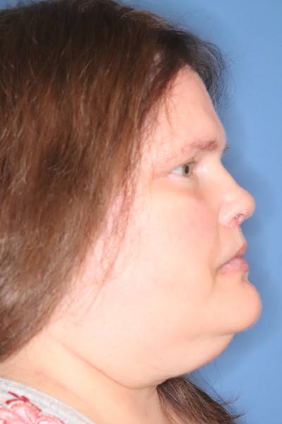 Rhinoplasty Before & After Gallery - Patient 77036996 - Image 8