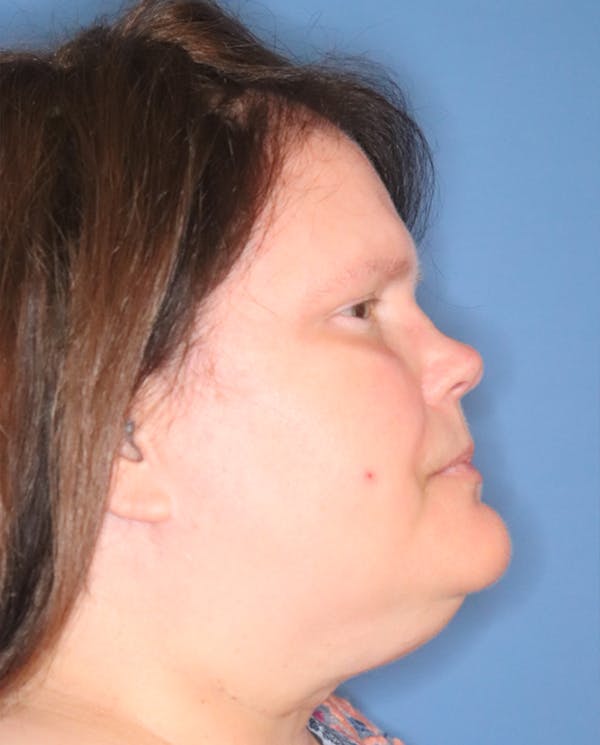 Exosome Facial Before & After Gallery - Patient 77037631 - Image 6