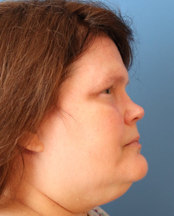 Exosome Facial Before & After Gallery - Patient 77037631 - Image 5
