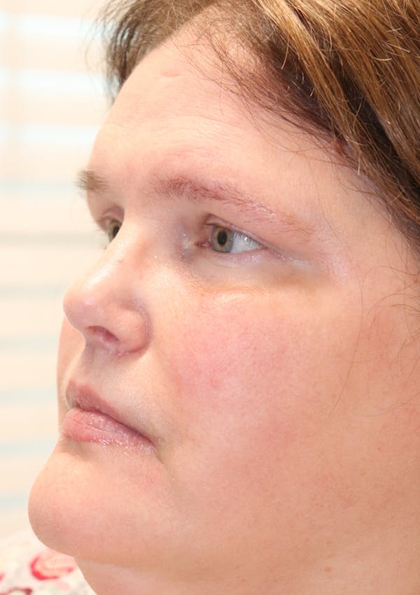 Cheek & Under Eye Filler Before & After Gallery - Patient 145843859 - Image 4