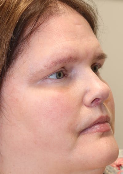 Cheek & Under Eye Filler Before & After Gallery - Patient 145843859 - Image 6