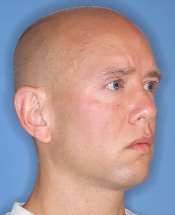 Cheek & Under Eye Filler Before & After Gallery - Patient 144976911 - Image 2