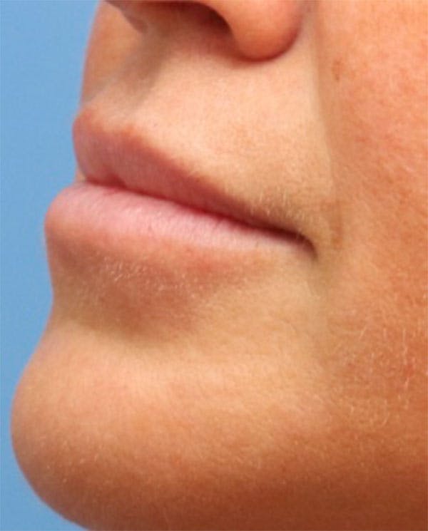 Lip Filler Before & After Gallery - Patient 144976901 - Image 3