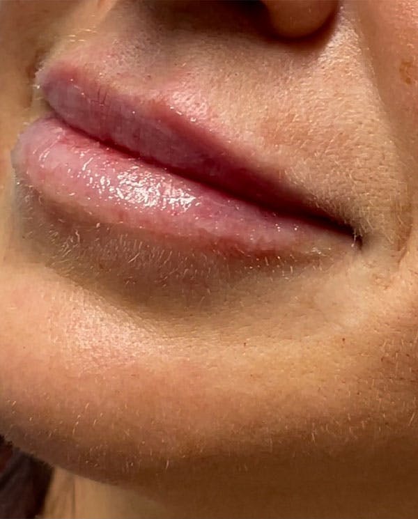 Lip Filler Before & After Gallery - Patient 144976901 - Image 4