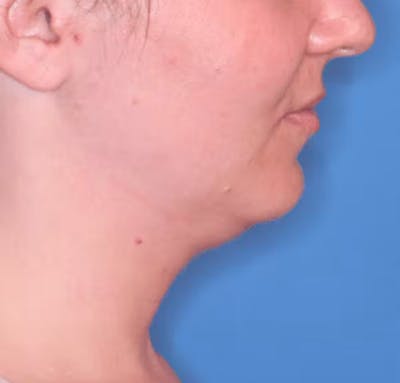 Facial Liposuction Before & After Gallery - Patient 102425576 - Image 1