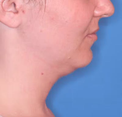 Facial Liposuction Before & After Gallery - Patient 102425576 - Image 1