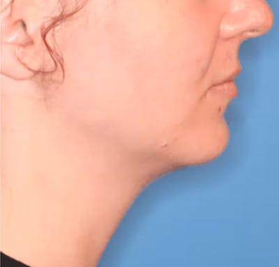 Facial Liposuction Before & After Gallery - Patient 102425576 - Image 2