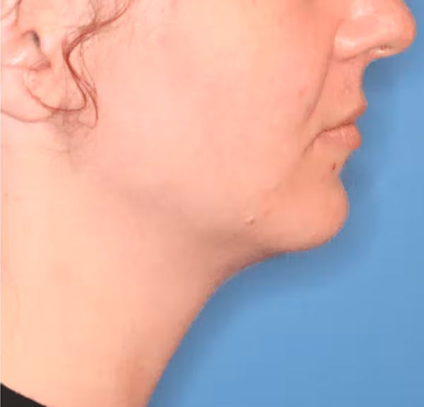 Facial Liposuction Gallery - Patient 102425576 - Image 2