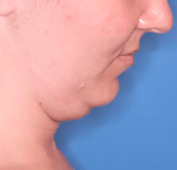 Facial Liposuction Before & After Gallery - Patient 102425576 - Image 3