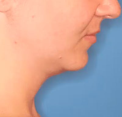 Facial Liposuction Before & After Gallery - Patient 102425576 - Image 4