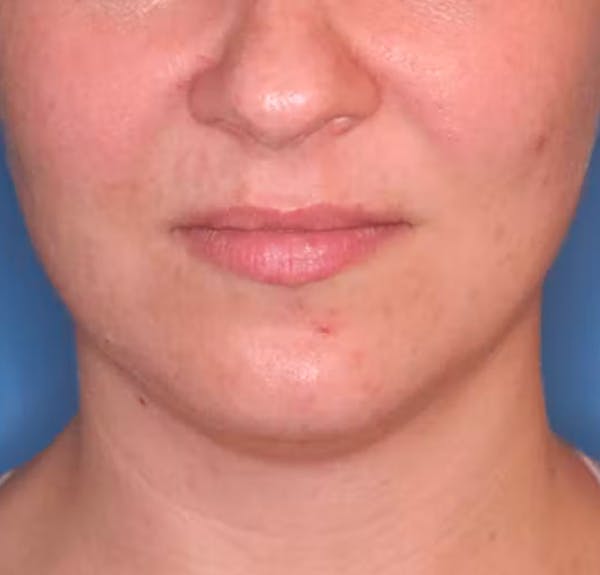 Facial Liposuction Before & After Gallery - Patient 102425576 - Image 5