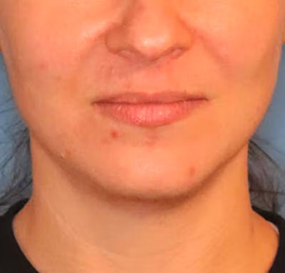 Facial Liposuction Before & After Gallery - Patient 102425576 - Image 6