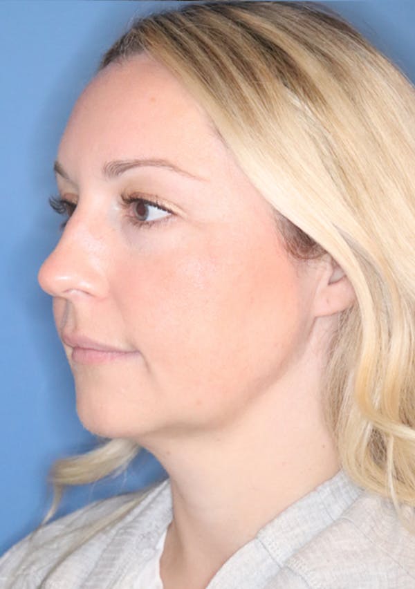 Buccal Fat Removal Before & After Gallery - Patient 120346784 - Image 3