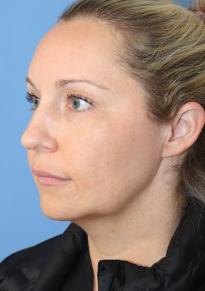 Buccal Fat Removal Before & After Gallery - Patient 120346784 - Image 4