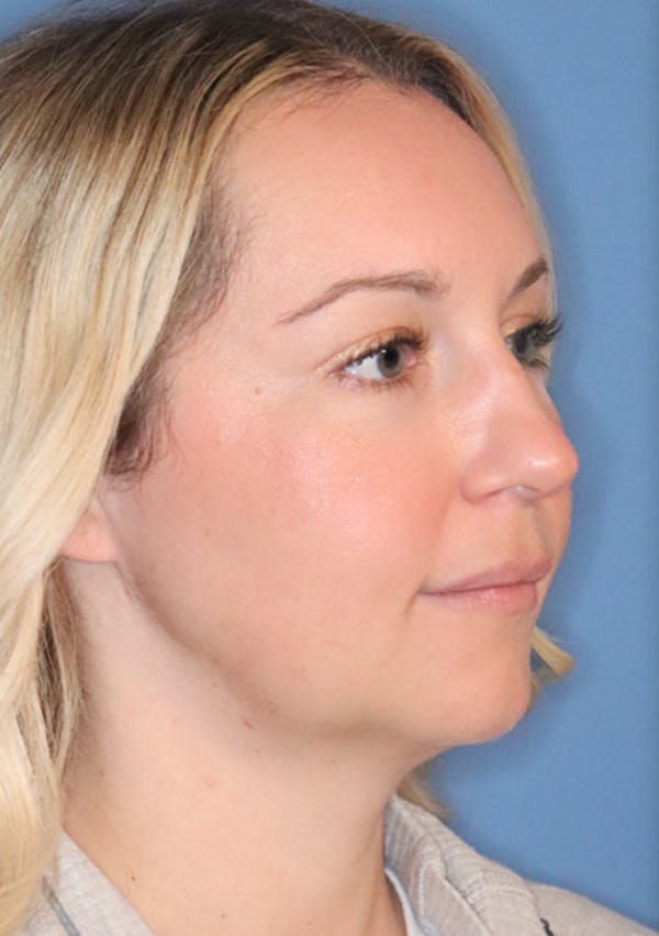 Buccal Fat Removal Gallery - Patient 120346784 - Image 5