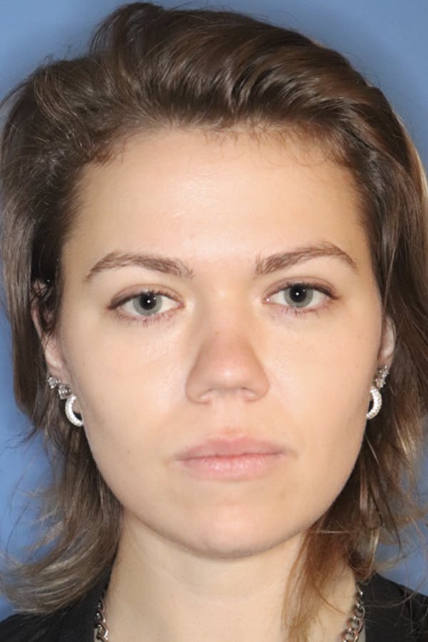 Rhinoplasty Before & After Gallery - Patient 120346808 - Image 1