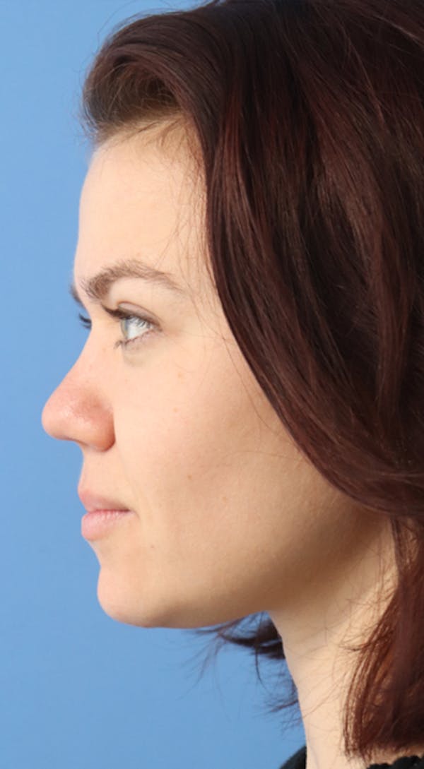 Rhinoplasty Before & After Gallery - Patient 120346808 - Image 4