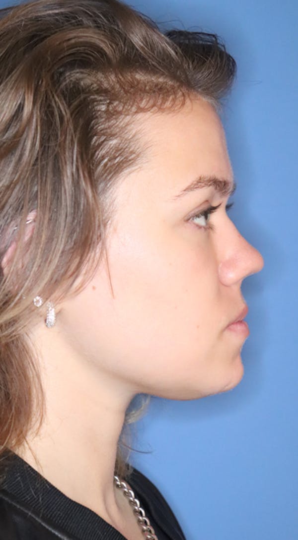 Rhinoplasty Before & After Gallery - Patient 120346808 - Image 7